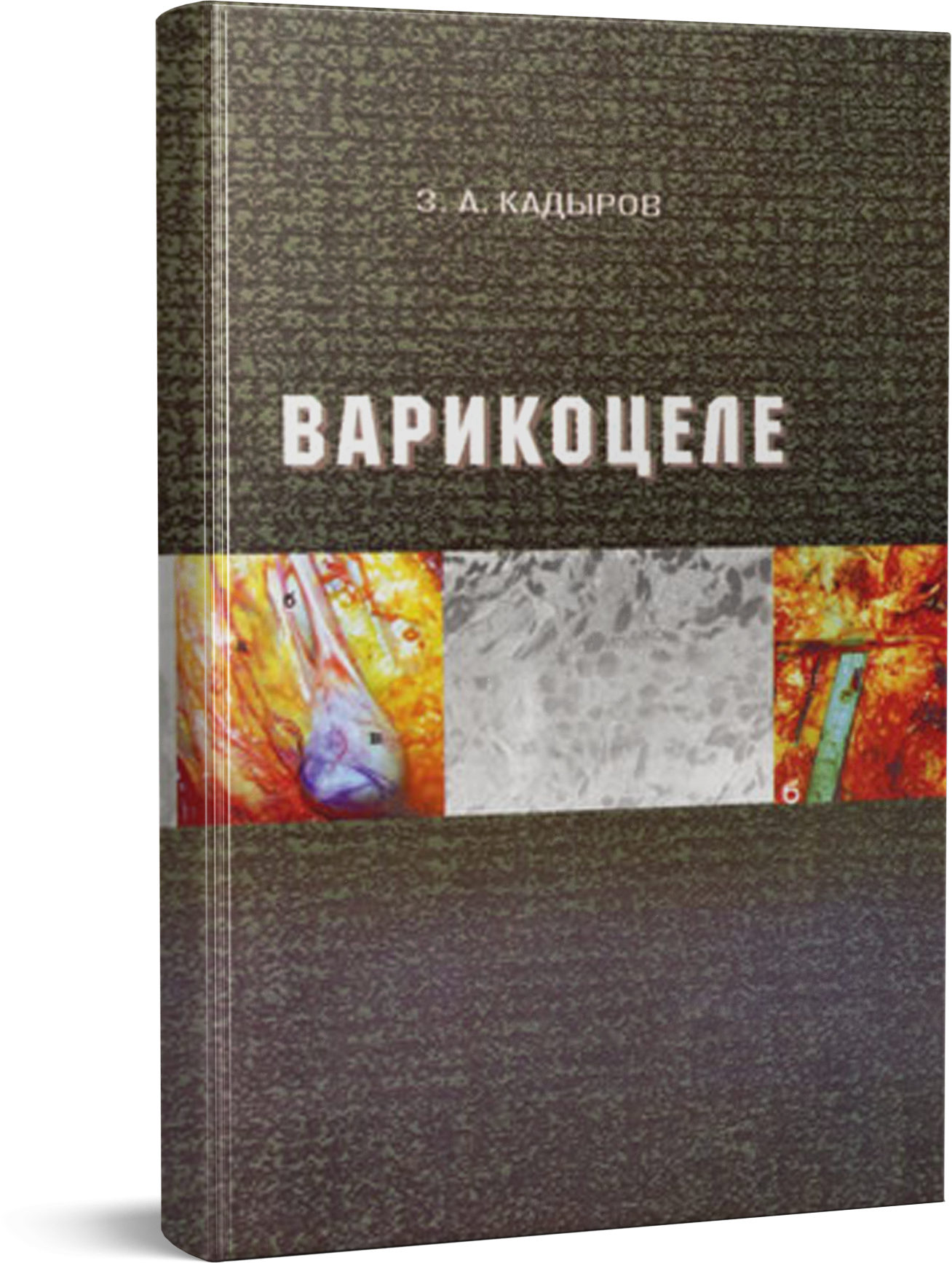 Варикоцеле - З.А. Кадыров